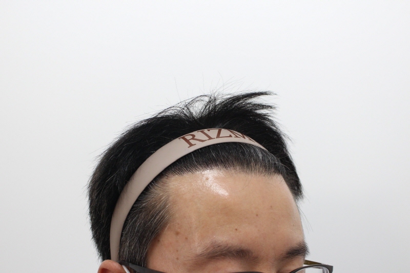 2[크기변환]수술후 365일차.jpg