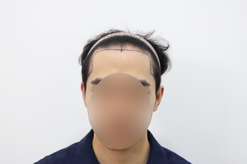 수술전.jpg