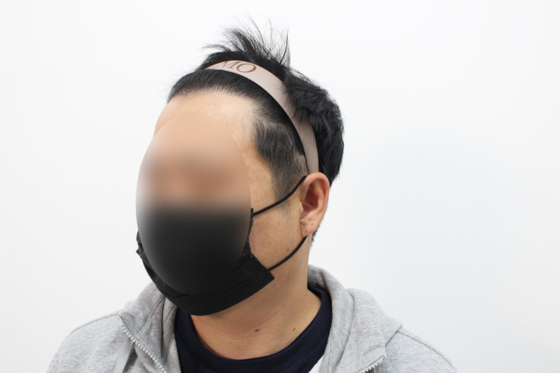 [크기변환]수술후 8개월차 풀샷dd.jpg