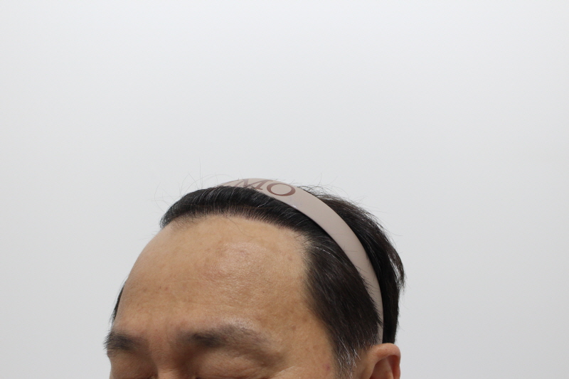2[크기변환]수술후 8개월차-옆 헤어라인도 생겼습니다.jpg