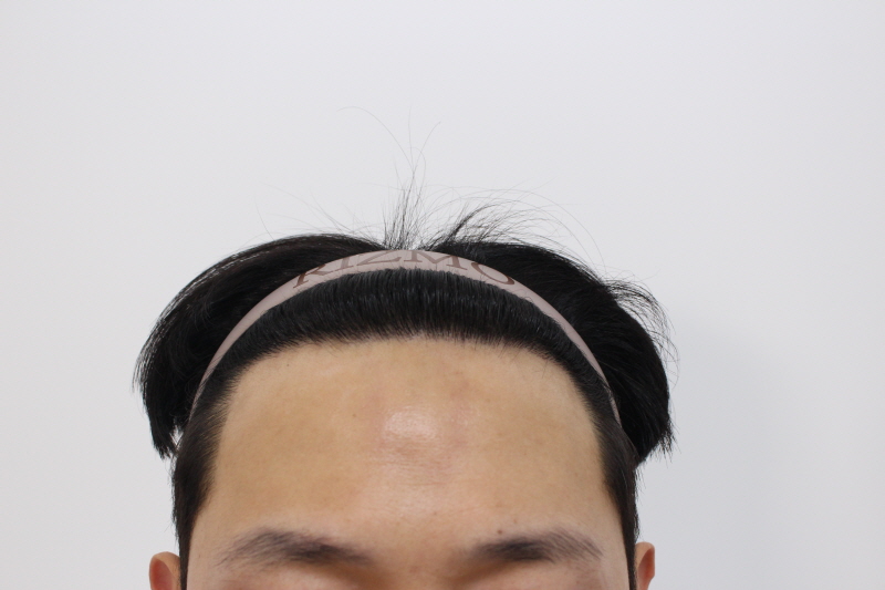 6. 수술후 10개월차.jpg