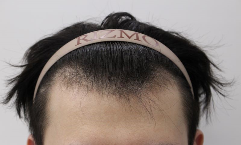 대전모발이식 리즈모의원 수술전 모습입니다.jpg