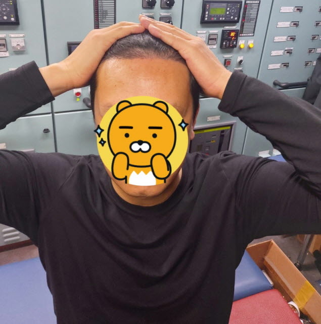 M자 2800모 이식 후 4개월 경과 된 후기입니다