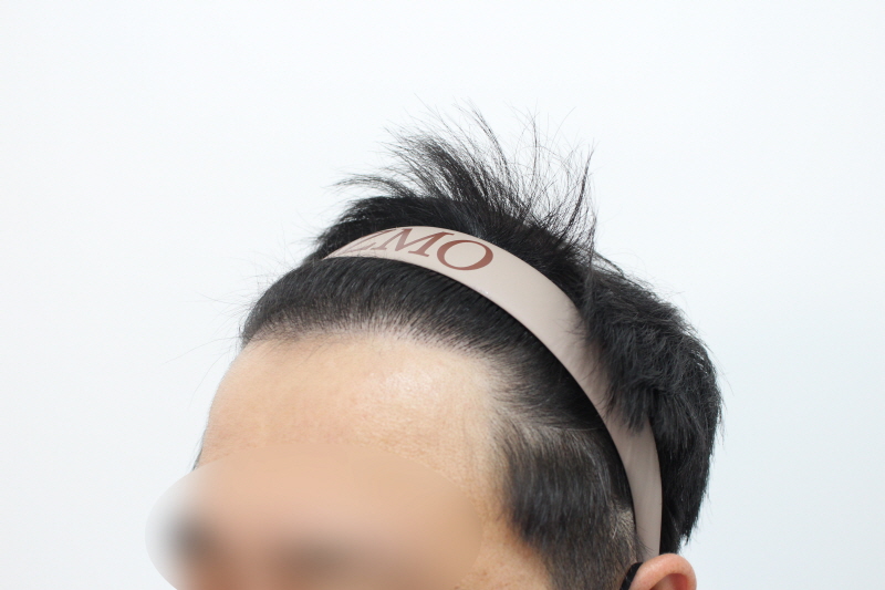 [크기변환]수술후 8개월차ff.jpg