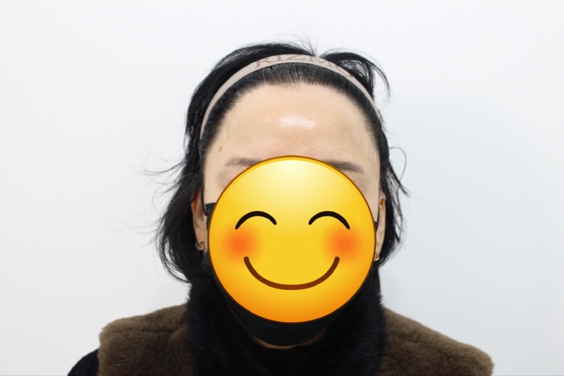[크기변환]수술후 1년차 여성헤어라인.jpg