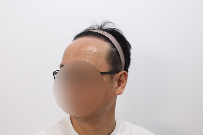 14. 수술후 12개월.jpg