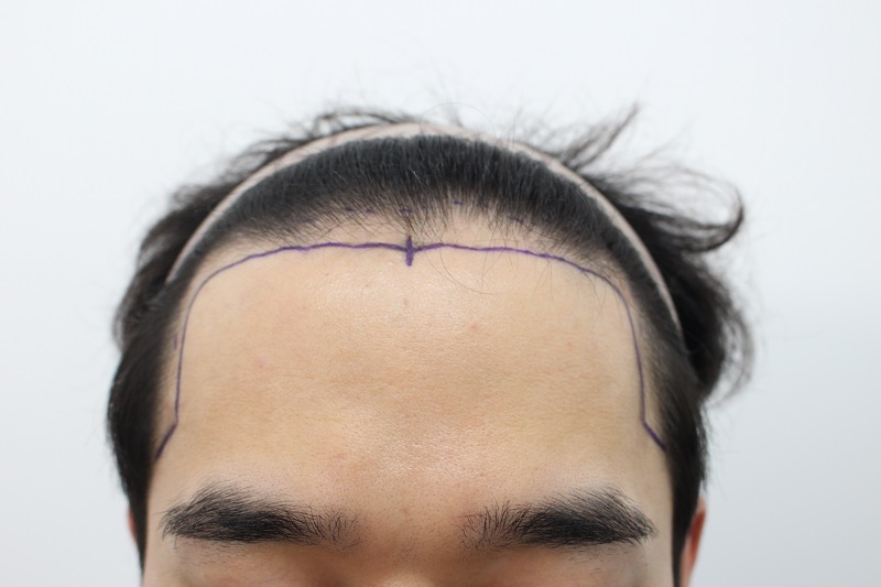 수술전 디자인 2.jpg