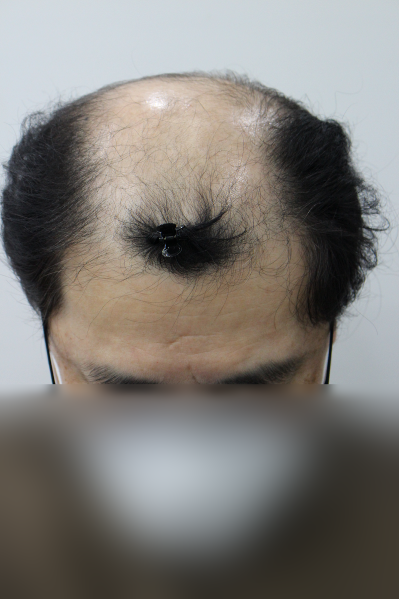 5000모 50대 모발이식 8개월 경과입니다.