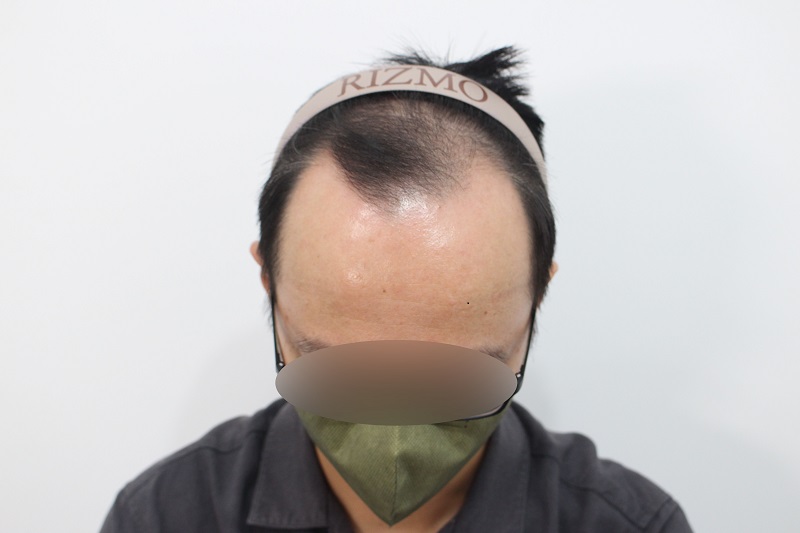 3. 수술전.jpg