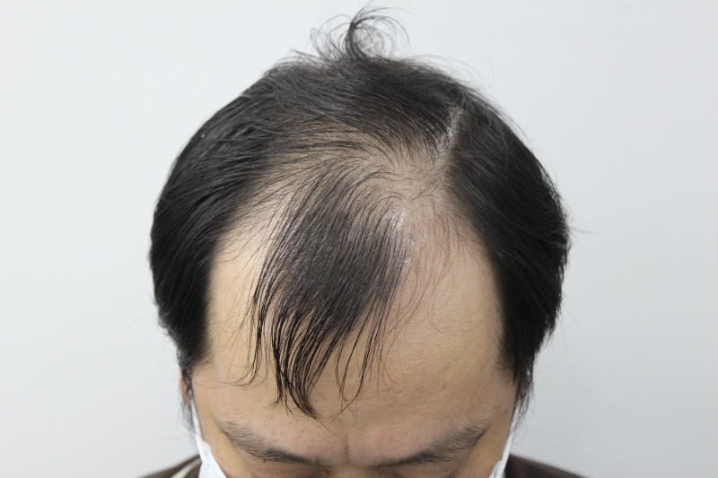 부산 리즈모에서 5000모 비절개 8개월차