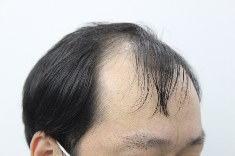 부산 리즈모의원 비절개 모발이식 1년 후기입니다.