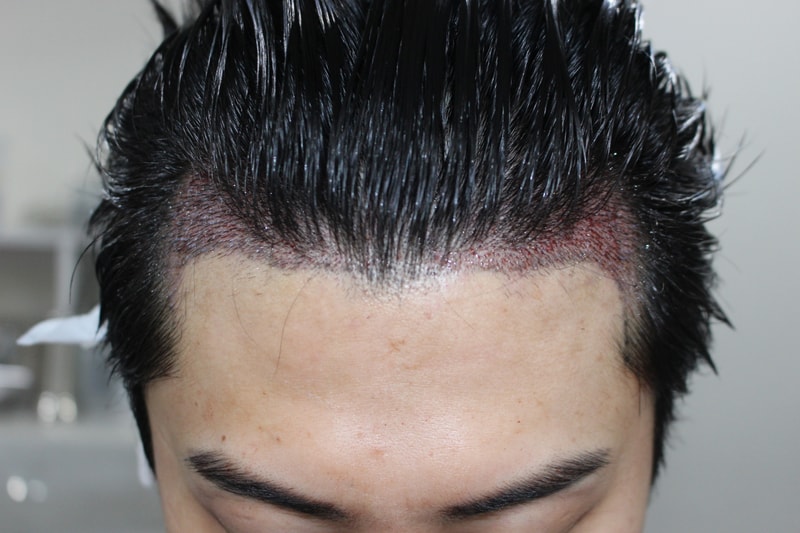 수술후.jpg