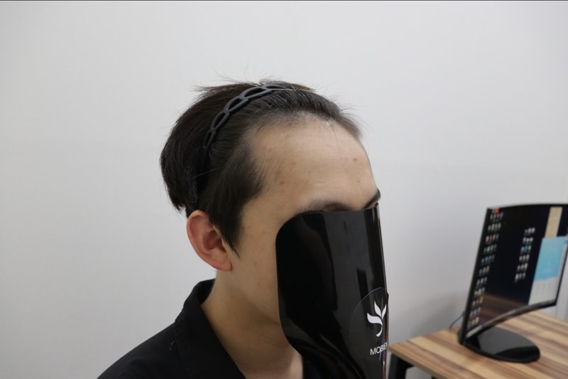 광주 압구정 모비앙의원 모발이식 1년경과 후기
