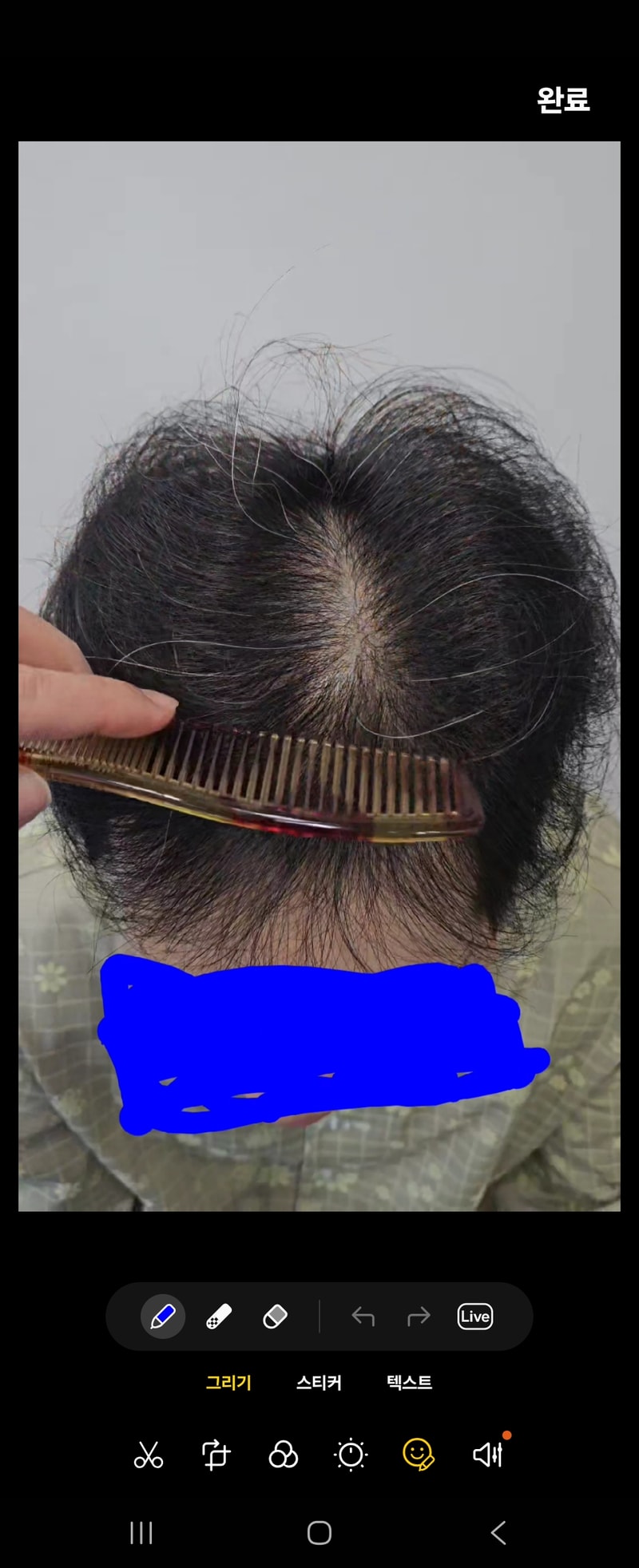 植毛手術直後の体験談です。
