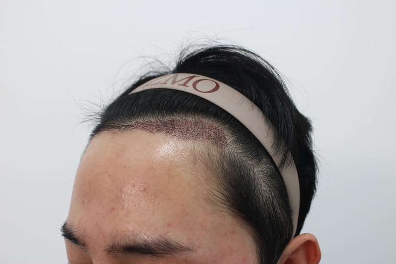 수술후 2주차 측면.jpg