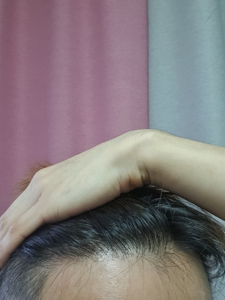 한나이브 수술 후 4년 반이 지났네요