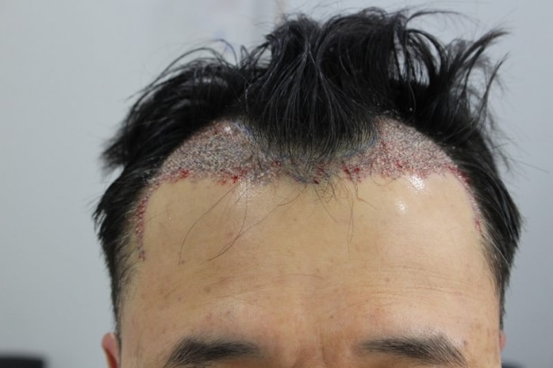 모앤블레스 엠자비절개수술받았어요...3200모