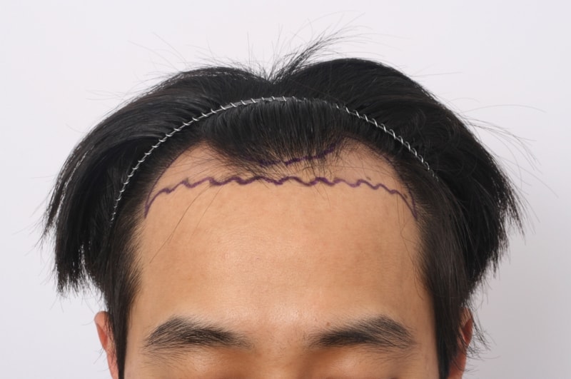 2 수술전디자인.jpg