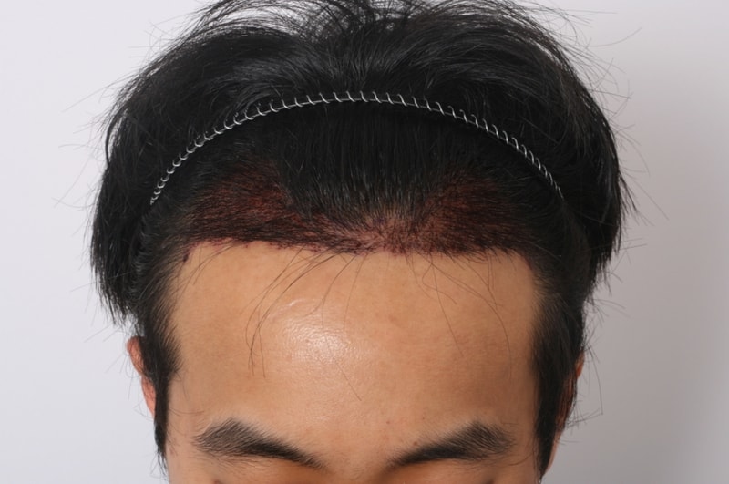 4 수술다음날.jpg