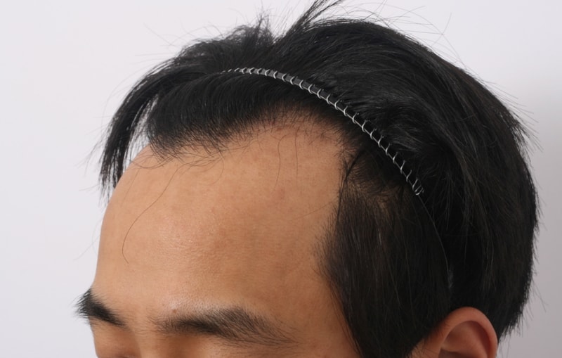 1 수술전 (3).jpg