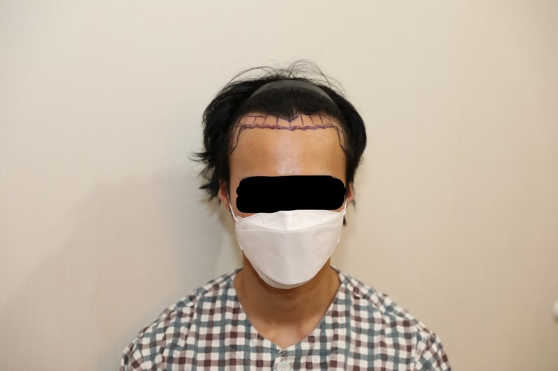 New Hair Clinic incision 1700 hair follicle hair transplant review