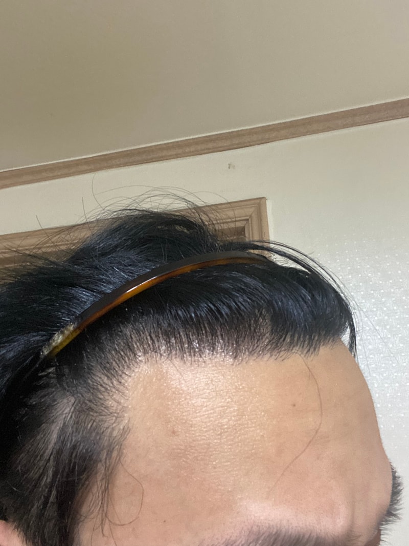 New Hair incision M-shaped hair transplant 1700 hair follicle late stage