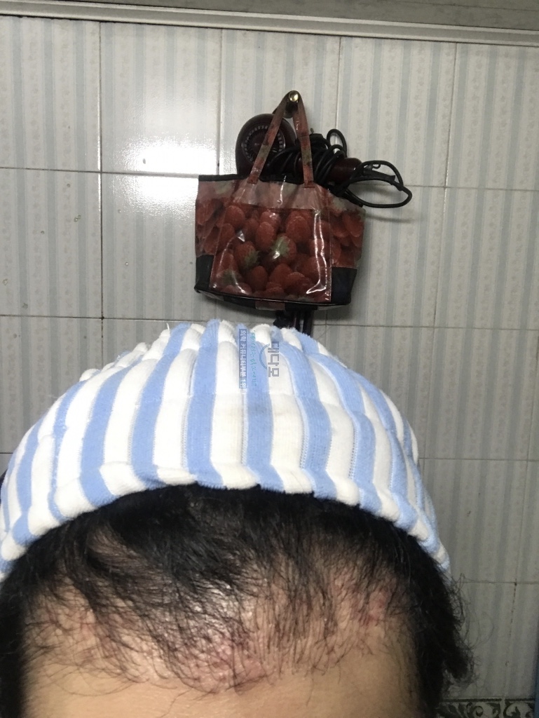 1차 이식 실패 후 JP에서 2차 재수술 받았습니다.