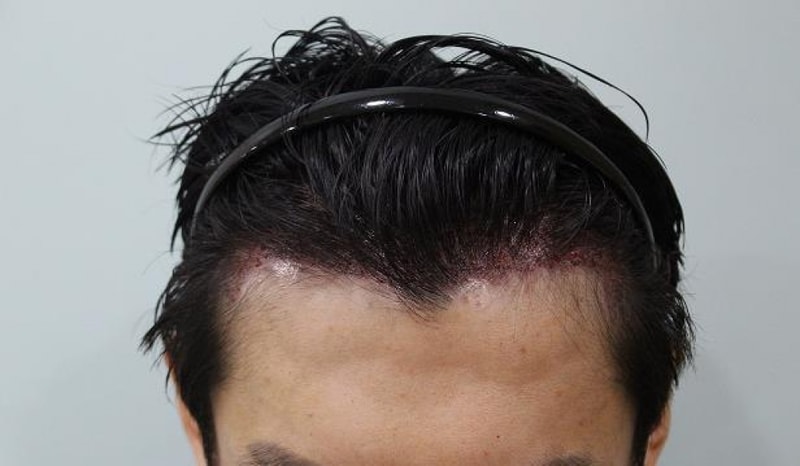 수술직후1.JPG