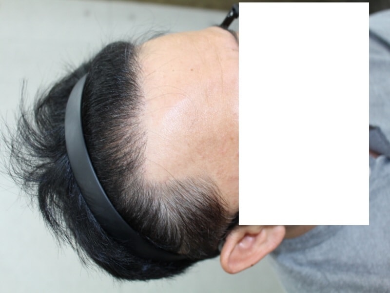 수술후 우.JPG
