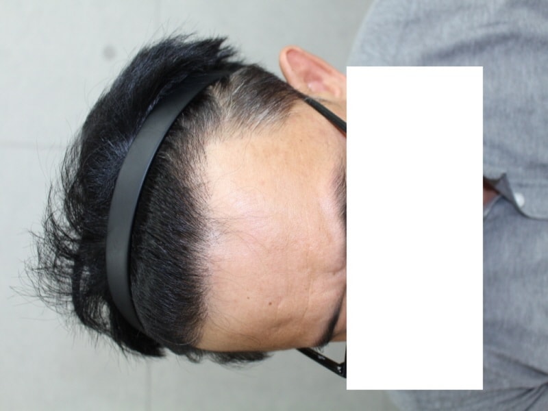 수술후좌.JPG