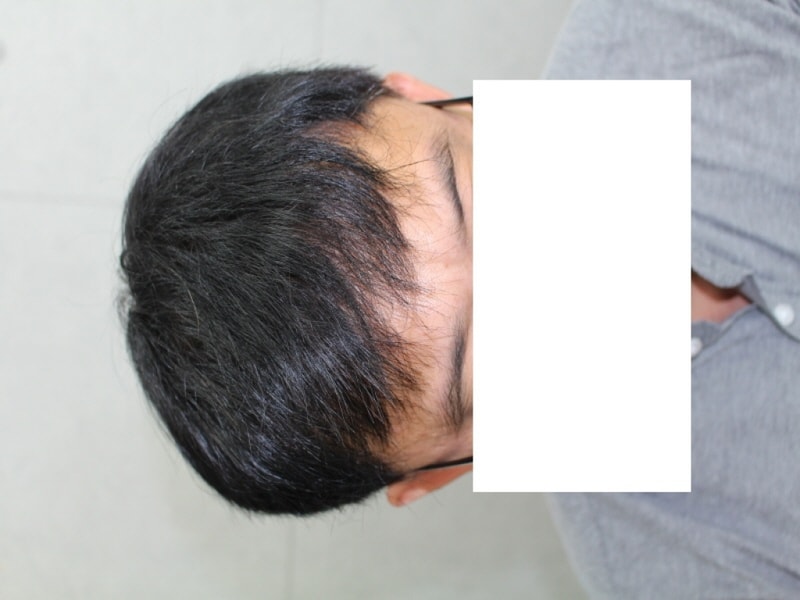 수술후정면.JPG