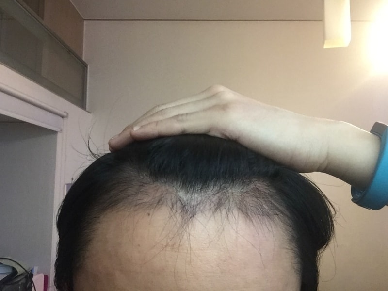 엠자,옆라인,구렛나루 4개월차