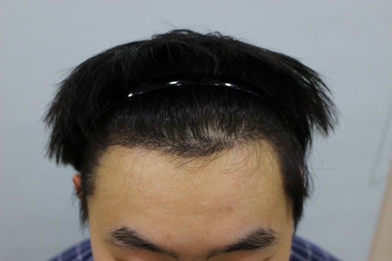 수술후 10일 (7).JPG