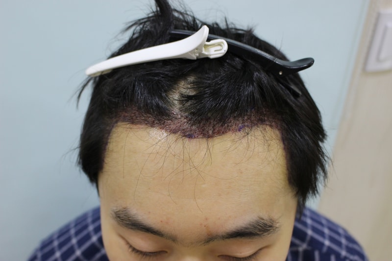 수술후 1일 (1).JPG