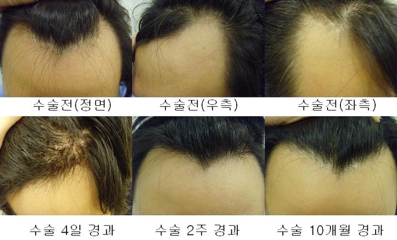 수술사진(보자르).JPG