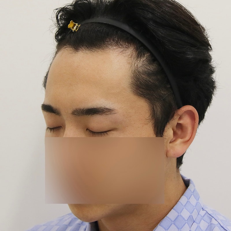 부산 엠자 모발이식 2주 후기 공유합니다!!_맘모스헤어라인 부산점