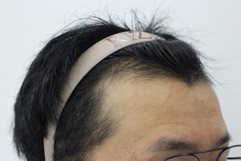 수술전 오른쪽.jpg