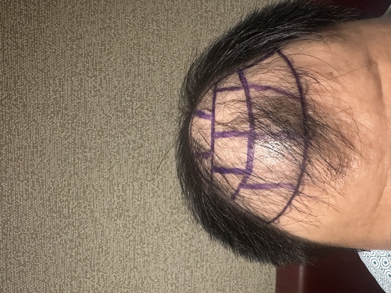 [NEWHAiR] This is a review after 2500 hair follicle surgery on day 2 of non-cut Hair Transplant.