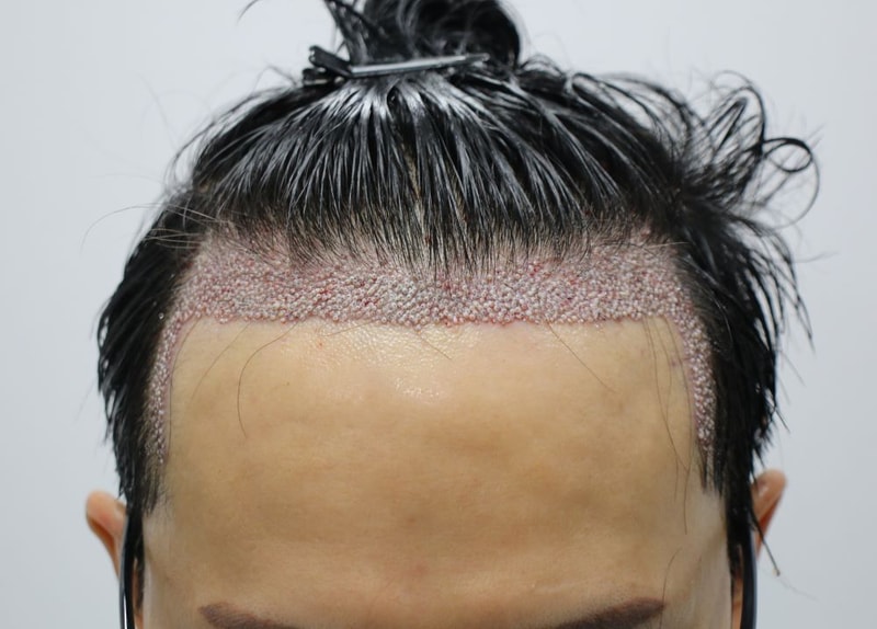 03.수술당일.JPG