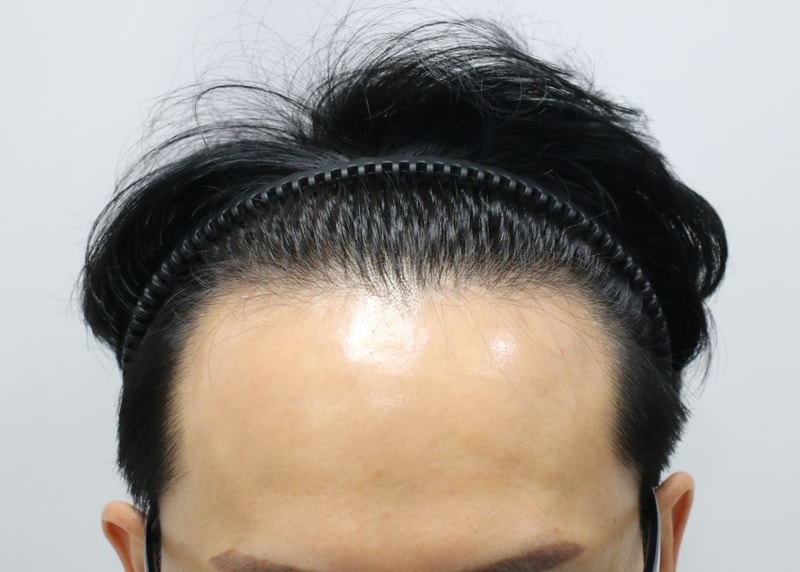 01.수술전.JPG