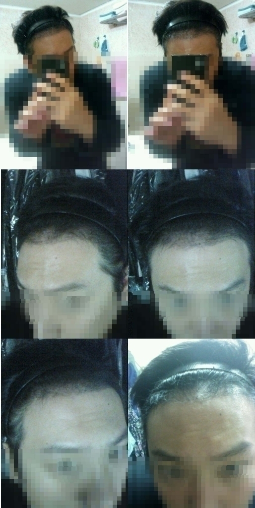 수술113일차.jpg