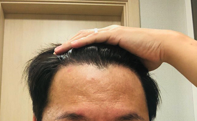 수술 9개월.jpg