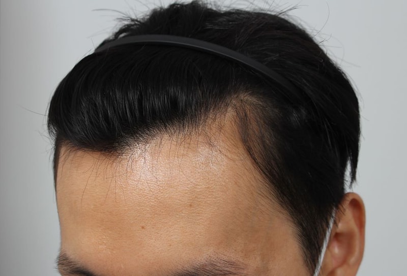 부산 포헤어 비절개무삭발 M자탈모 8달 완전득모