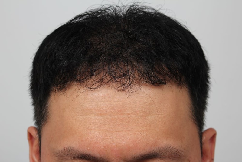 02.포헤어수술후.JPG