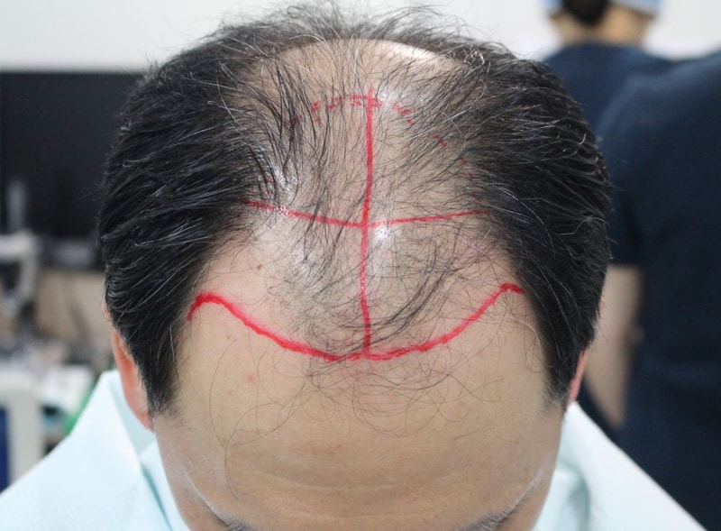 전두부 5000모 대량이식 부산포헤어 6개월 후기