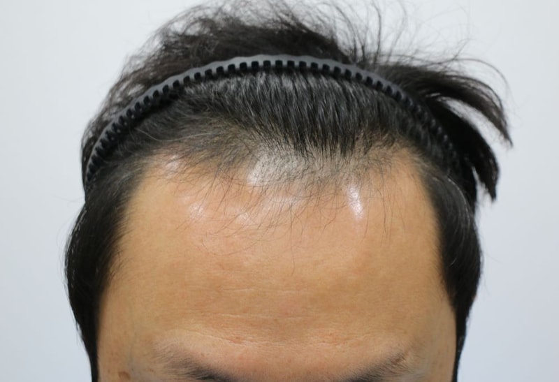 포헤어 비절개슬릿 2000모낭 9개월 진심으로 감사합니다