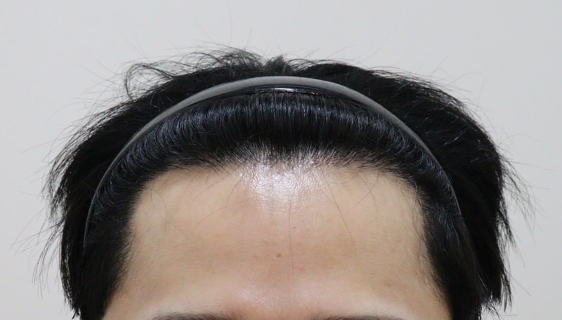 4. 수술후_6개월_1.JPG