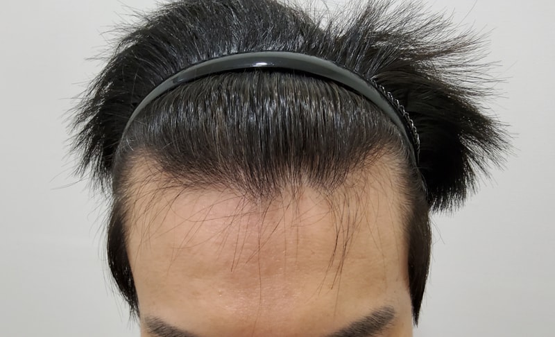 It's already been six months since the hair transplant~~