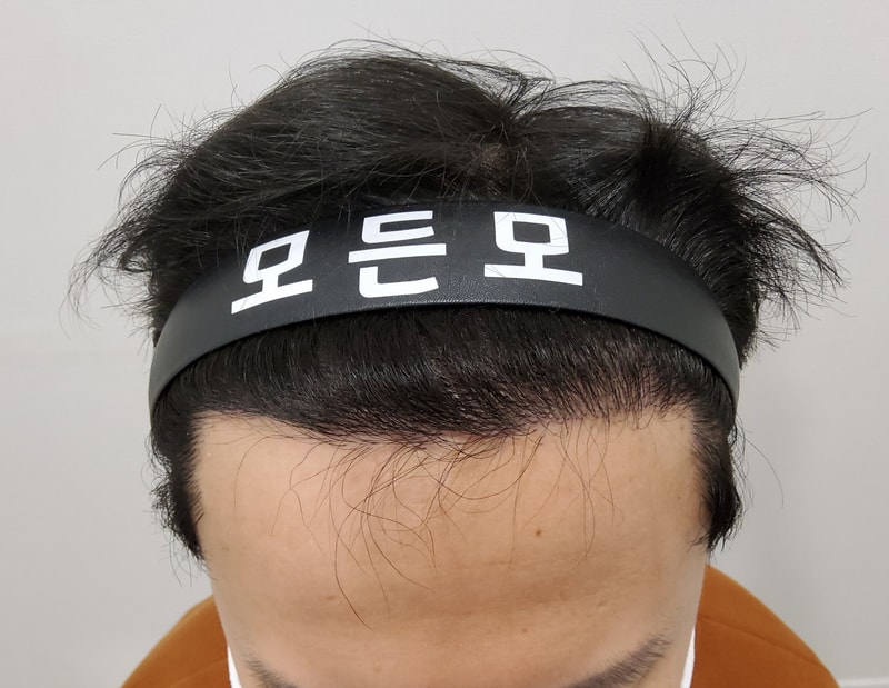 2. 수술후_6개월_2.jpg