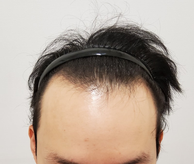 1. 수술전_1.jpg